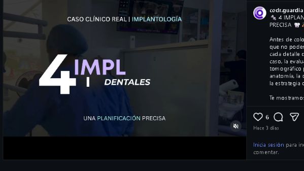 Portada del Reel del Centro Odontológico Dr. Guardia sobre la planificación de cuatro implantes